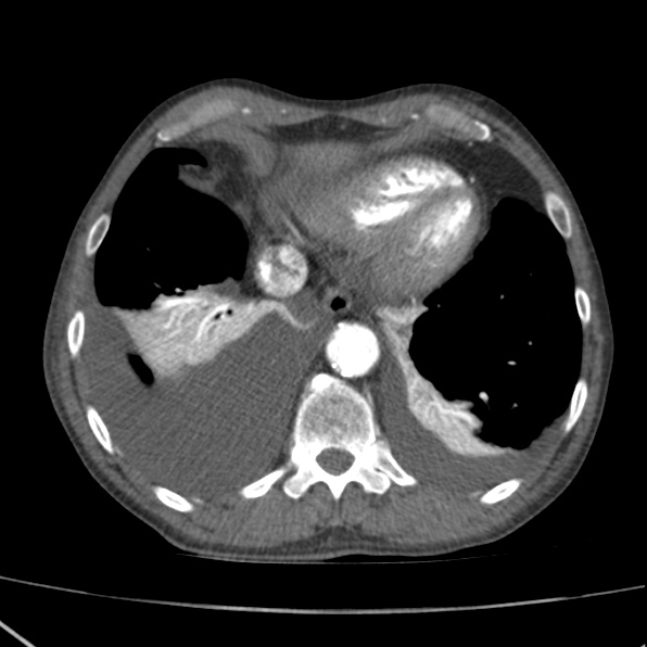 File:Aortoiliac occlusive disease (Radiopaedia 32134-33076 G 6).jpg