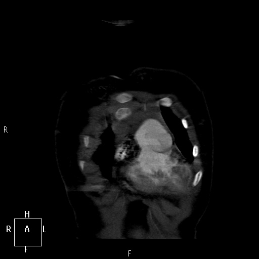 File:Aortopulmonary septal defect (Radiopaedia 41990-45013 Coronal C+ CTPA 1).jpg