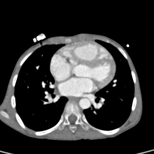 File:Aortopulmonary window, interrupted aortic arch and large PDA giving the descending aorta (Radiopaedia 35573-37074 B 51).jpg