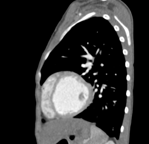 File:Aortopulmonary window, interrupted aortic arch and large PDA giving the descending aorta (Radiopaedia 35573-37074 C 41).jpg