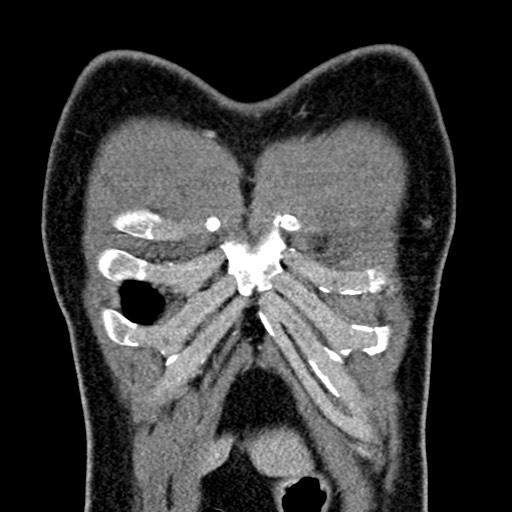 Apical lung mass mimic - neurogenic tumor (Radiopaedia 59918-67521 B 33).jpg
