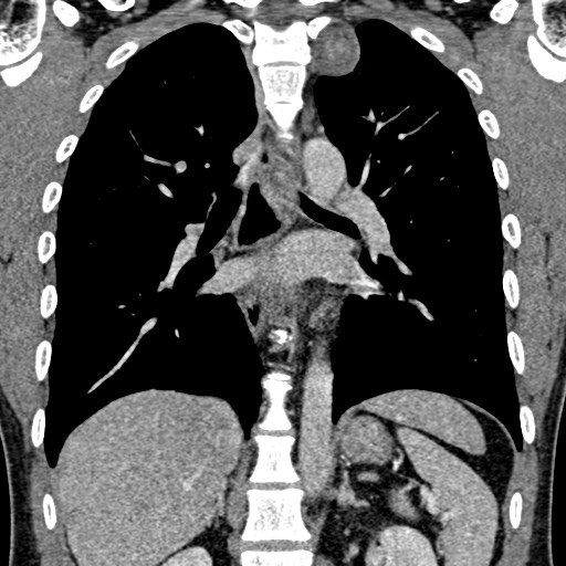 File:Apical lung mass mimic - neurogenic tumor (Radiopaedia 59918-67521 B 70).jpg