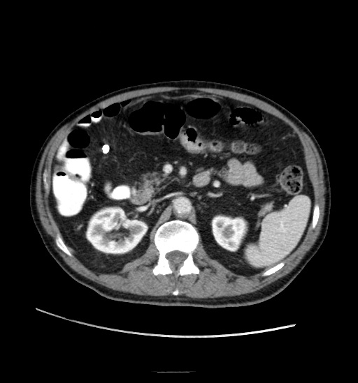 Appendicitis with localized perforation and abscess formation (Radiopaedia 49035-54130 A 36).jpg