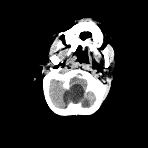 Arachnoid cyst-posterior fossa (Radiopaedia 88661-105370 Axial non-contrast 10).jpg