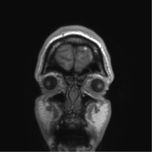 Arachnoid cyst with subdural hematoma (Radiopaedia 85892-101743 Coronal T1 87).png