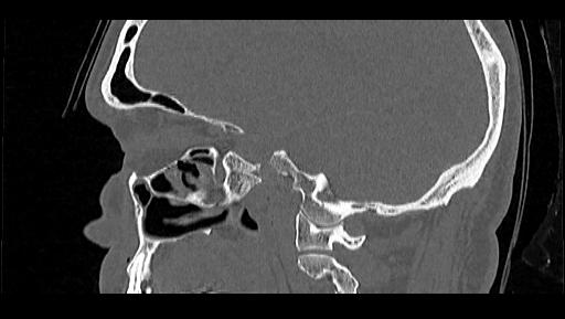 Arcuate foramen (Radiopaedia 89833-106944 Sagittal bone window 86).jpg