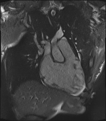 File:Arrhythmogenic right ventricular cardiomyopathy (Radiopaedia 57972-64966 CINE R2 SSFP 43).jpg