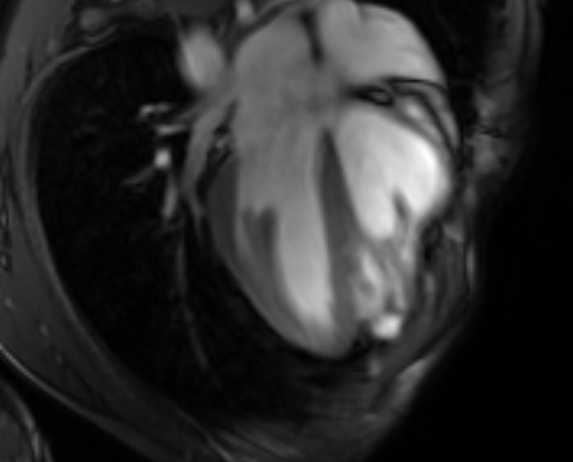 File:Arrhythmogenic right ventricular cardiomyopathy (Radiopaedia 69564-79464 4ch cine 48).jpg