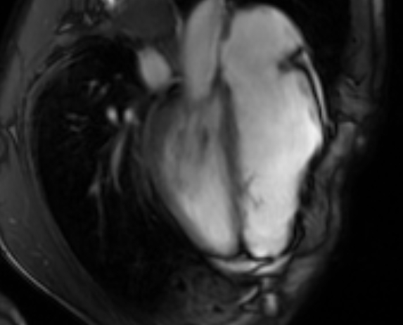 Arrhythmogenic right ventricular cardiomyopathy (Radiopaedia 69564-79464 4ch cine 91).jpg