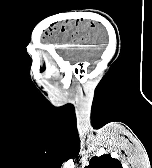 Arrow injury to the brain (Radiopaedia 72101-82607 H 50).jpg
