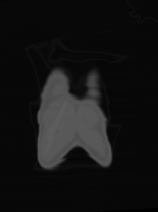 Arrow injury to the neck (Radiopaedia 75225-86323 Coronal bone window 8).jpg