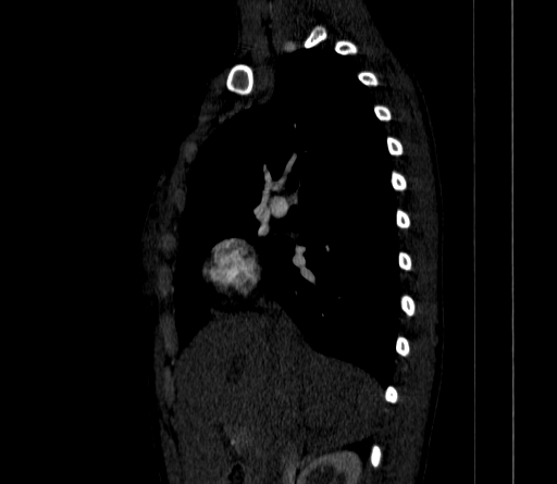 Arteria lusoria (Radiopaedia 88528-105192 C 40).jpg