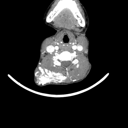 Arteriovenous malformation of the neck (Radiopaedia 53935-60062 A 26).jpg