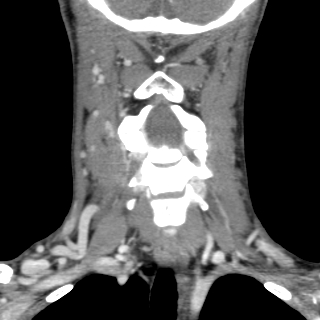 File:Arteriovenous malformation of the neck (Radiopaedia 53935-60062 D 14).jpg