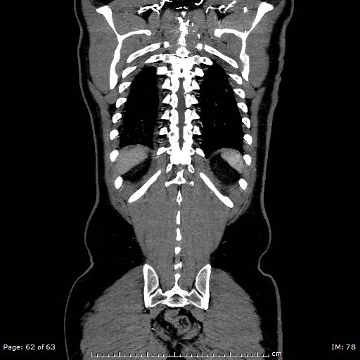 Ascending aortic aneurysm (Radiopaedia 50086-55404 B 62).jpg