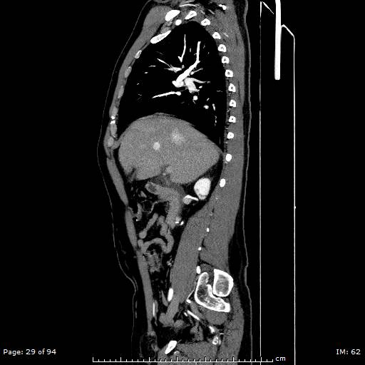 Ascending aortic aneurysm (Radiopaedia 50086-55404 C 21).jpg