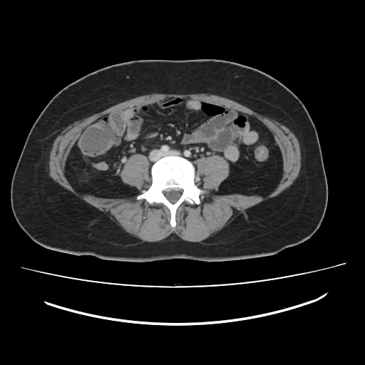 File:Ascending retrocecal appendicitis with liver abscesses (Radiopaedia 60066-67615 B 58).jpg