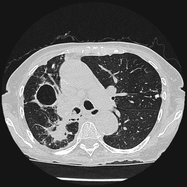 Aspergilloma (Radiopaedia 24458-24763 Axial lung window 26).jpg