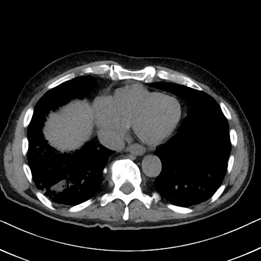 Aspergilloma on background pulmonary fibrosis (Radiopaedia 60942-68757 Axial non-contrast 42).jpg