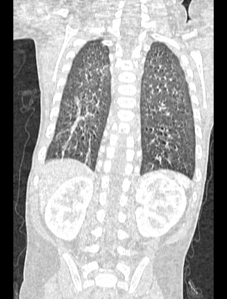 Asplenia syndrome (Radiopaedia 73083-83792 Coronal lung window 109).jpg