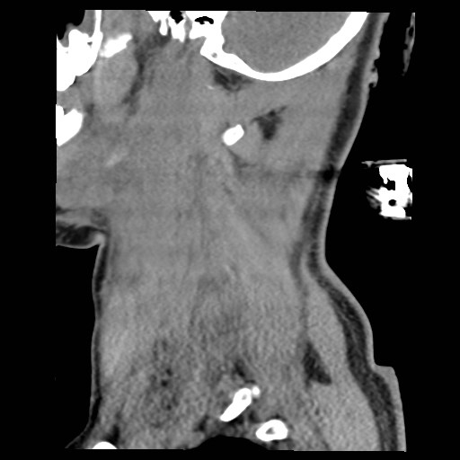 File:Atlanto-occipital dislocation (Radiopaedia 44648-48412 A 26).jpg