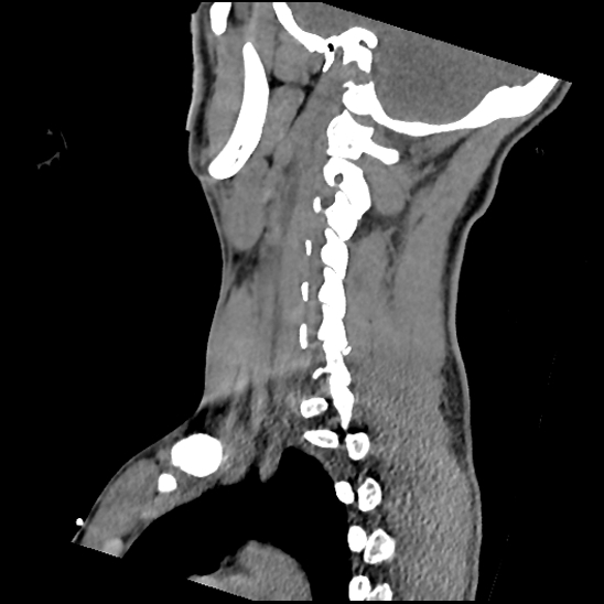File:Atlanto-occipital dissociation (Traynelis type 1), C2 teardrop fracture, C6-7 facet joint dislocation (Radiopaedia 87655-104061 D 57).jpg
