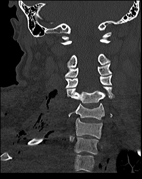 Atlanto-occipital dissociation - Traynelis type 1 (Radiopaedia 87570-103948 Coronal bone window 35).jpg