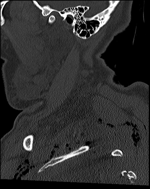 Atlanto-occipital dissociation - Traynelis type 1 (Radiopaedia 87570-103948 Sagittal bone window 18).jpg
