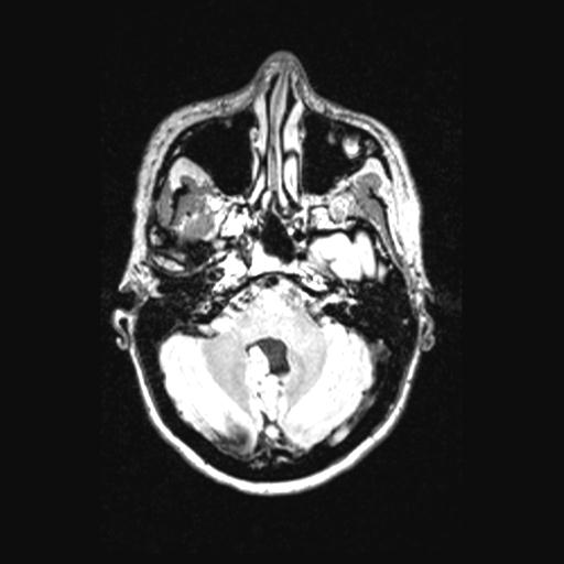 Atretic encephalocoele with inferior vermis hypoplasia (Radiopaedia 30443-31108 Axial 43).jpg