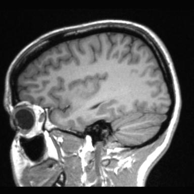 Atretic encephalocoele with inferior vermis hypoplasia (Radiopaedia 30443-31108 Sagittal T1 99).jpg
