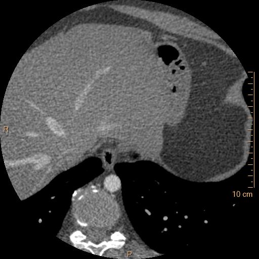 Atrial septal defect (upper sinus venosus type) with partial anomalous pulmonary venous return into superior vena cava (Radiopaedia 73228-83961 A 272).jpg