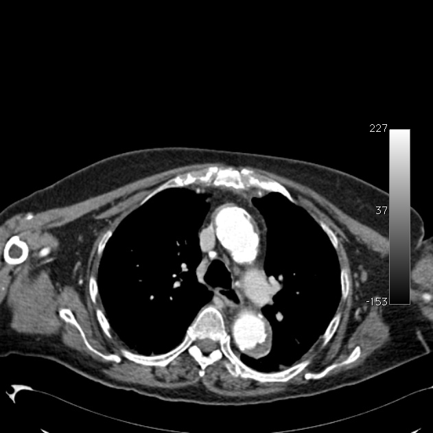Atypical dissection of the thoracic aorta (Radiopaedia 10975-11393 A 21).jpg
