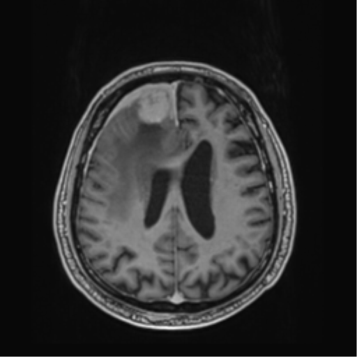 Atypical meningioma (WHO grade II) with brain invasion (Radiopaedia 57767-64729 Axial T1 C+ 33).png