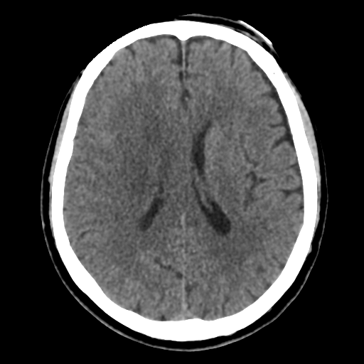 Atypical meningioma with skull invasion (Radiopaedia 34357-35649 Axial non-contrast 32).png