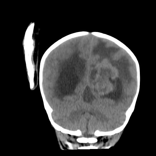 Atypical teratoid rhabdoid tumor (AT-RT) (Radiopaedia 85823-101654 Coronal non-contrast 38).jpg