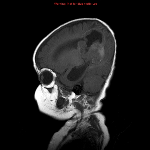 File:Atypical teratoid rhabdoid tumor (Radiopaedia 10712-11183 Sagittal T1 15).jpg