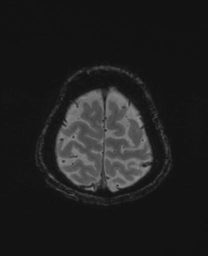 Autoimmune limbic encephalitis (Radiopaedia 30363-31005 SWI - magnitude 72).jpg
