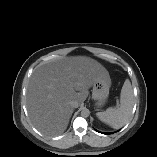 Autosomal dominant polycystic kidney disease (Radiopaedia 50259-55612 Axial non-contrast 22).jpg