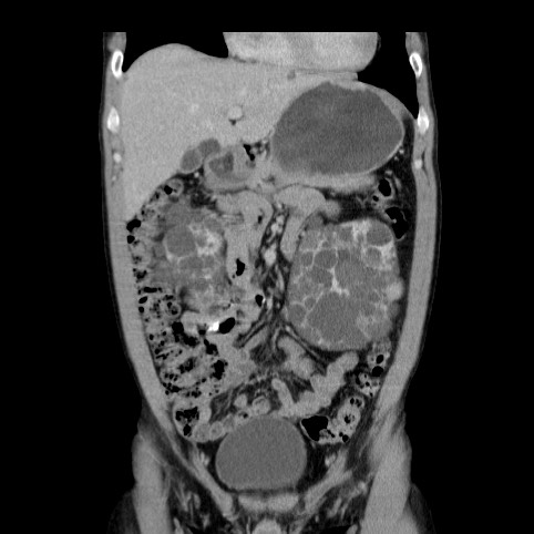 Autosomal dominant polycystic kidney disease (Radiopaedia 66349-75582 A 19).jpg