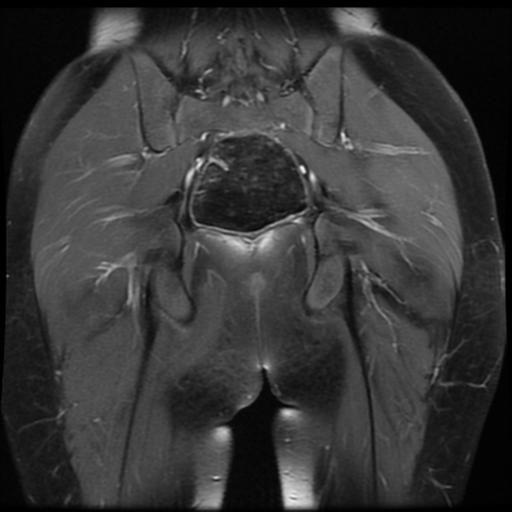 File:Avascular necrosis of the hip (Radiopaedia 29563-30067 I 15).jpg