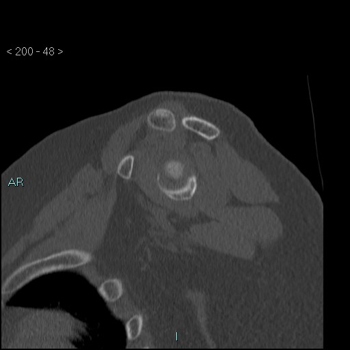 Avascular necrosis of the shoulder - Cruess stage I (Radiopaedia 77674-89887 Sagittal bone window 47).jpg