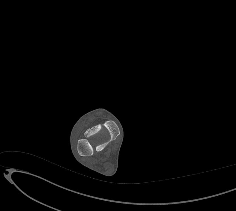 Avulsion fractures of talus and calcaneus (Radiopaedia 48277-53155 Axial bone window 3).jpg