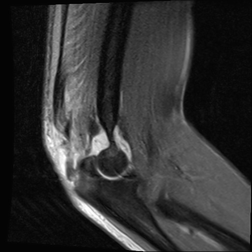File:Avulsion of the triceps tendon (Radiopaedia 42919-46154 Sagittal PD fat sat 4).jpg