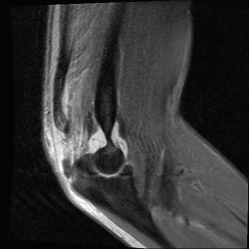 File:Avulsion of the triceps tendon (Radiopaedia 42919-46154 Sagittal PD fat sat 5).jpg