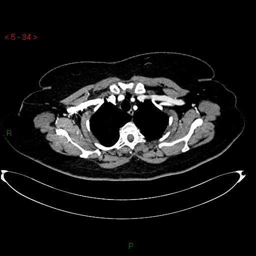 File:Azygos fissure and lobe (Radiopaedia 47620-52278 A 20).jpg