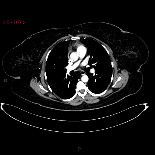 Azygos fissure and lobe (Radiopaedia 47620-52278 A 93).jpg