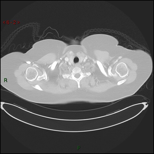 Azygos fissure and lobe (Radiopaedia 47620-52278 Axial lung window 2).jpg