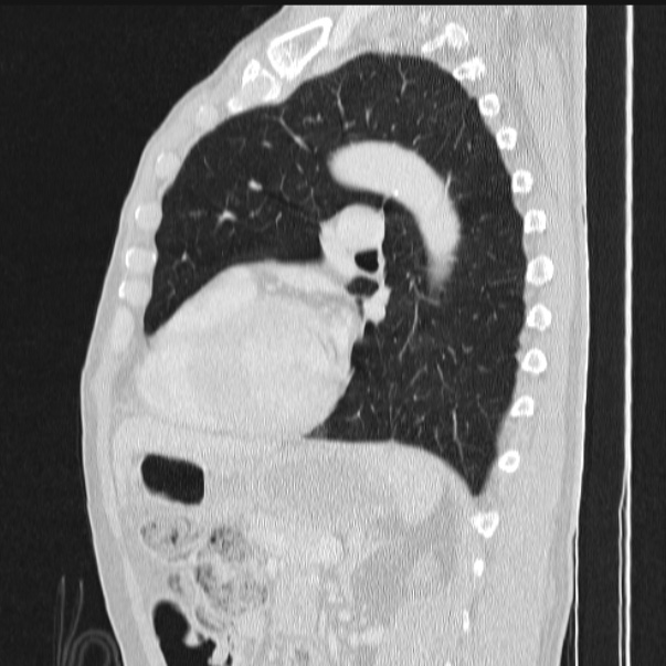 Azygos lobe (Radiopaedia 38259-40275 lung window 62).jpg