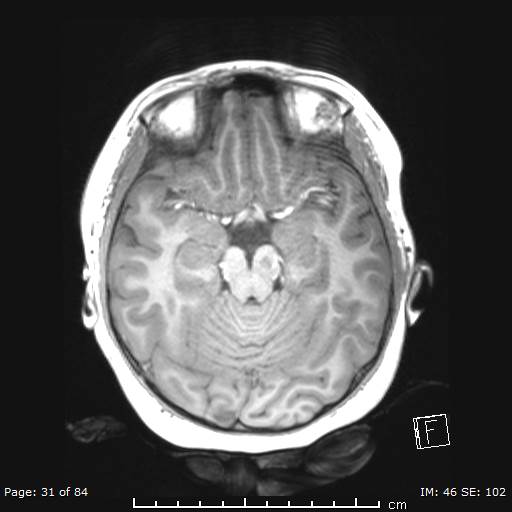 Balo concentric sclerosis (Radiopaedia 61637-69636 Axial T1 31).jpg