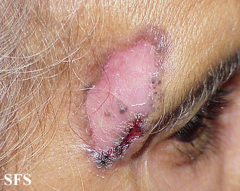 Basal Cell Carcinoma (Dermatology Atlas 57).jpg